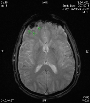 MRI AX Susc Image 24 10-27-13